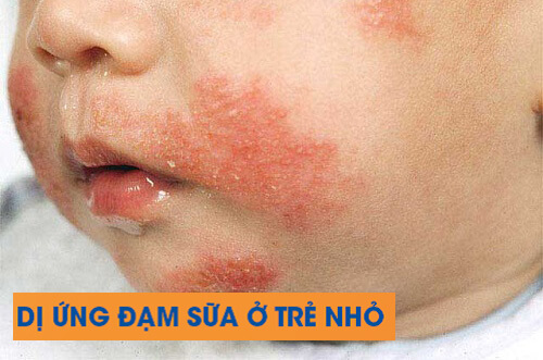 Dị ứng đạm sữa bò là tình trạng thường gặp ở trẻ sơ sinh