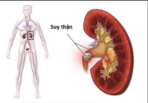 Phân vân về việc những loại sữa nào dành cho người bị suy thận và tiểu đường? Phân vân về việc những loại sữa nào dành cho người bị suy thận và tiểu đường?