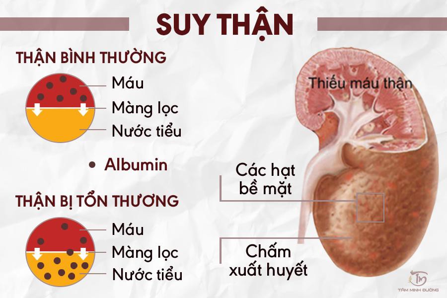 Bệnh thận có nên uống sữa hay không và những thông tin hữu ích dành cho bạn Bệnh thận có nên uống sữa hay không và những thông tin hữu ích dành cho bạn